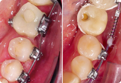 А.В. Тихонов – сужение зубного ряда с опорой на дентальный имплантат