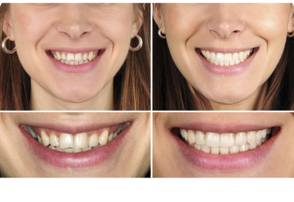 Коррекция арки улыбки и кривой Шпее интрузией с минивинтами