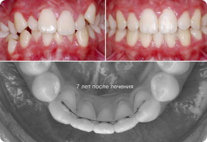 Сергей Тихонов – 5 условий, чтобы решиться на удаление резца!