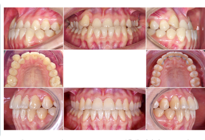 Как бы вы лечили эту пациентку с обратным перекрытием?