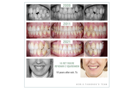 10 лет после лечения с удалением