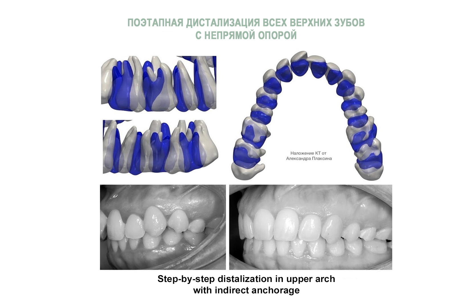 Поэтапная дистализация всех верхних зубов с непрямой опорой