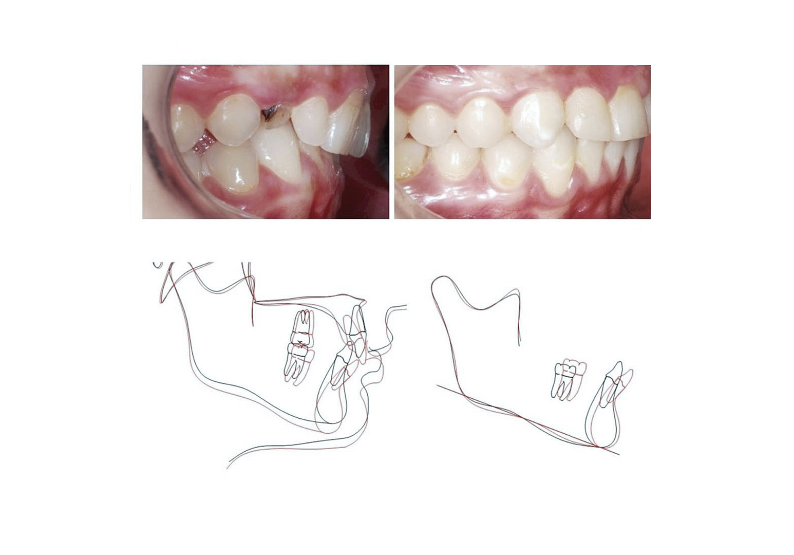 Лечение сагиттальных и вертикальных аномалий. Ошибки при коррекции 2 класса.