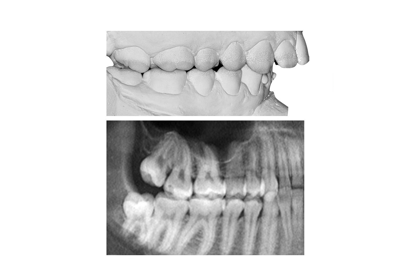 Дистализация или удаление?