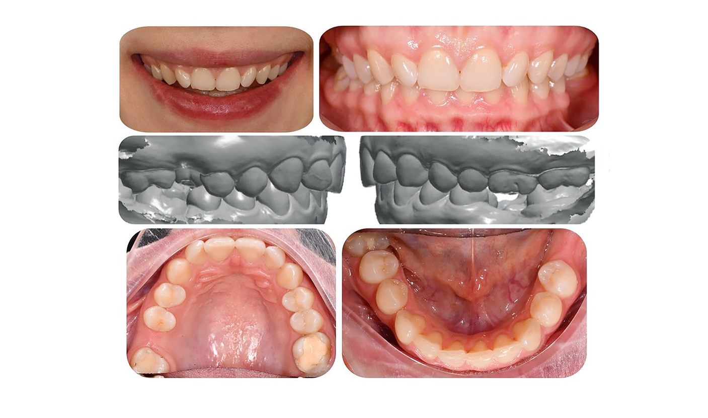 Как составляем план лечения? Пациентка хочет закрыть промежуток от 46 зуба.
