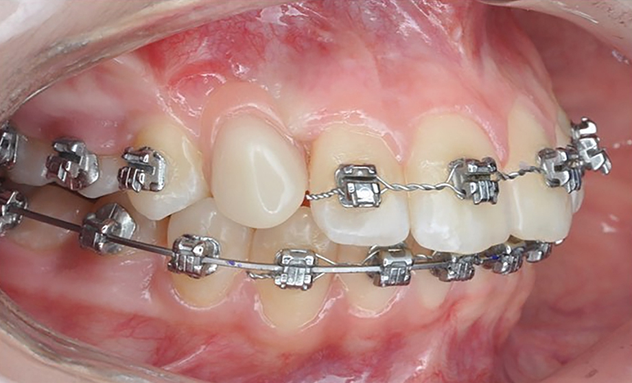 Временное протезирование клыка: от сканирования до установки