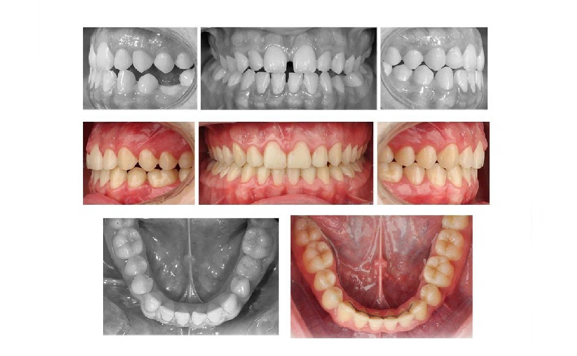 Уход от протезирования при адентии 5 зуба у подростка