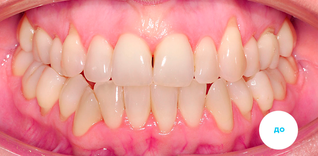 ЛЕЧЕНИЕ ПЕРЕКРЕСТНОГО ПРИКУСА, УСТРАНЕНИЕ СКУЧЕННОСТИ ЗУБОВ. 