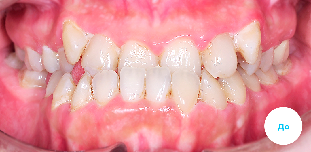 ЛЕЧЕНИЕ ПЕРЕКРЕСТНОГО ПРИКУСА, УСТРАНЕНИЕ СКУЧЕННОСТИ ЗУБОВ. 