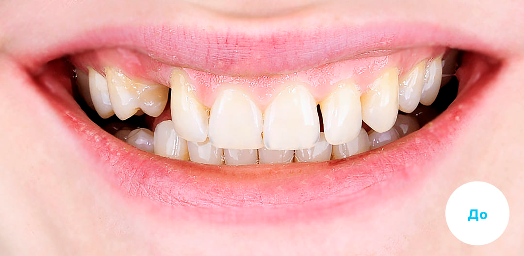 ЛЕЧЕНИЕ ПЕРЕКРЕСТНОГО ПРИКУСА, УСТРАНЕНИЕ СКУЧЕННОСТИ ЗУБОВ. 