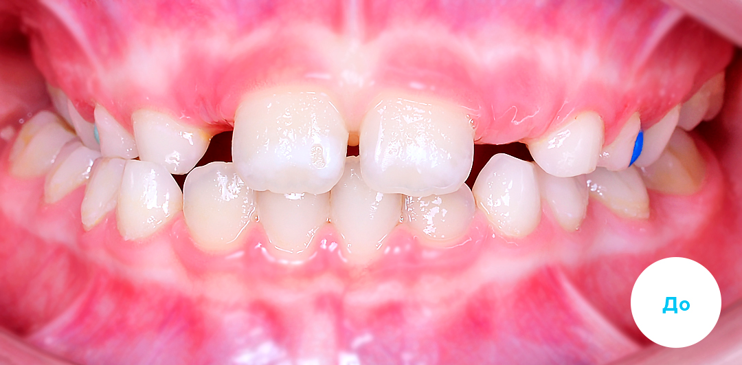 ЛЕЧЕНИЕ ПЕРЕКРЕСТНОГО ПРИКУСА, УСТРАНЕНИЕ СКУЧЕННОСТИ ЗУБОВ. 