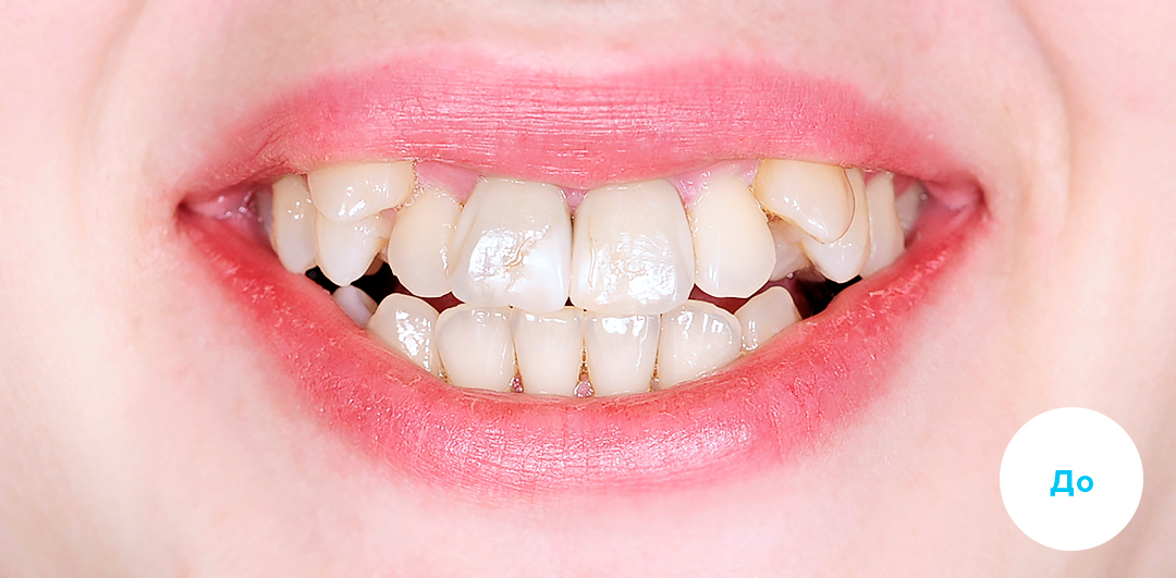 ЛЕЧЕНИЕ ПЕРЕКРЕСТНОГО ПРИКУСА, УСТРАНЕНИЕ СКУЧЕННОСТИ ЗУБОВ. 