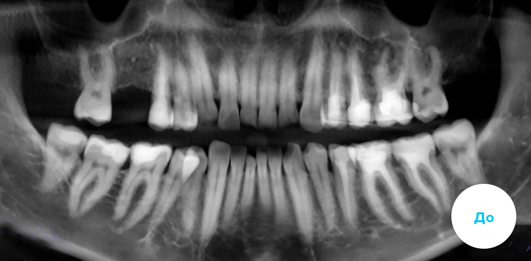 ЛЕЧЕНИЕ ПЕРЕКРЕСТНОГО ПРИКУСА, УСТРАНЕНИЕ СКУЧЕННОСТИ ЗУБОВ. 