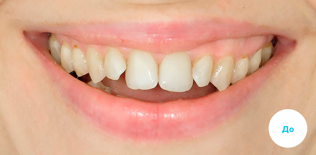 ЛЕЧЕНИЕ ПЕРЕКРЕСТНОГО ПРИКУСА, УСТРАНЕНИЕ СКУЧЕННОСТИ ЗУБОВ. 