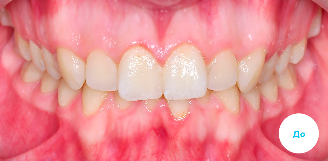 ЛЕЧЕНИЕ ПЕРЕКРЕСТНОГО ПРИКУСА, УСТРАНЕНИЕ СКУЧЕННОСТИ ЗУБОВ. 