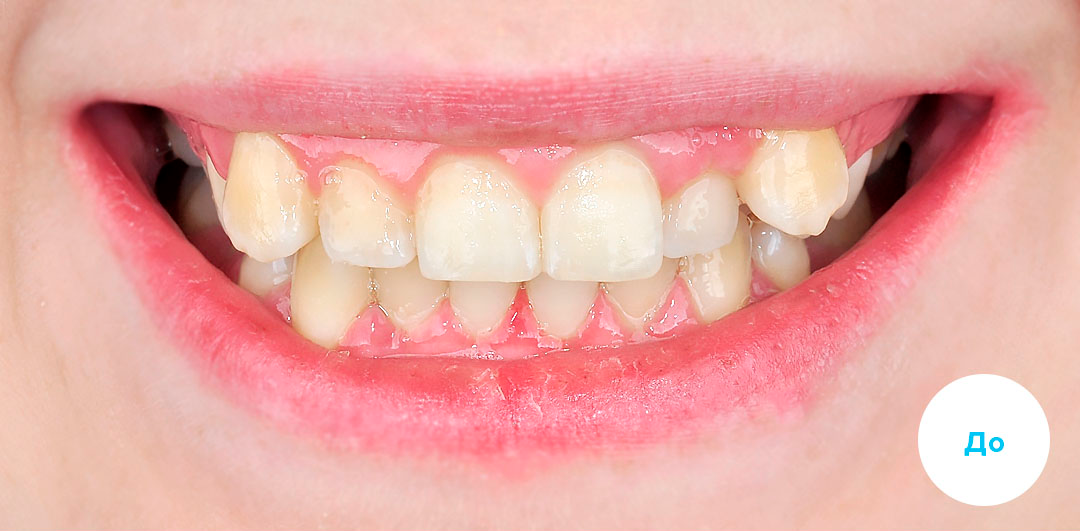 ЛЕЧЕНИЕ ПЕРЕКРЕСТНОГО ПРИКУСА, УСТРАНЕНИЕ СКУЧЕННОСТИ ЗУБОВ. 