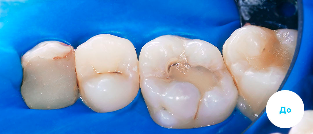 ЛЕЧЕНИЕ ПЕРЕКРЕСТНОГО ПРИКУСА, УСТРАНЕНИЕ СКУЧЕННОСТИ ЗУБОВ.