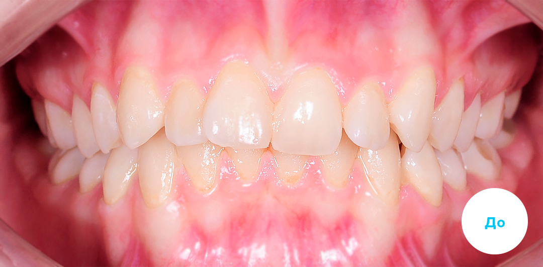 ЛЕЧЕНИЕ ПЕРЕКРЕСТНОГО ПРИКУСА, УСТРАНЕНИЕ СКУЧЕННОСТИ ЗУБОВ. 