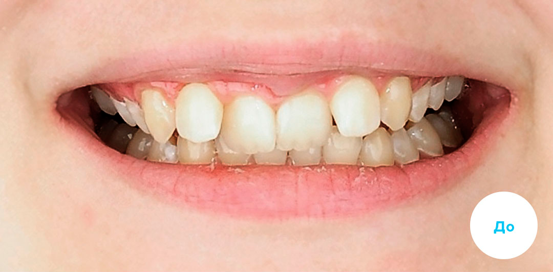 ЛЕЧЕНИЕ ПЕРЕКРЕСТНОГО ПРИКУСА, УСТРАНЕНИЕ СКУЧЕННОСТИ ЗУБОВ. 