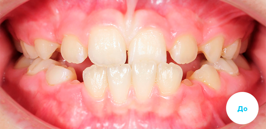 ЛЕЧЕНИЕ ПЕРЕКРЕСТНОГО ПРИКУСА, УСТРАНЕНИЕ СКУЧЕННОСТИ ЗУБОВ. 