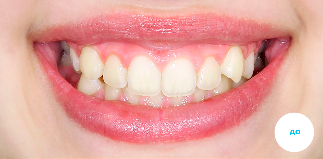 ЛЕЧЕНИЕ ПЕРЕКРЕСТНОГО ПРИКУСА, УСТРАНЕНИЕ СКУЧЕННОСТИ ЗУБОВ. 