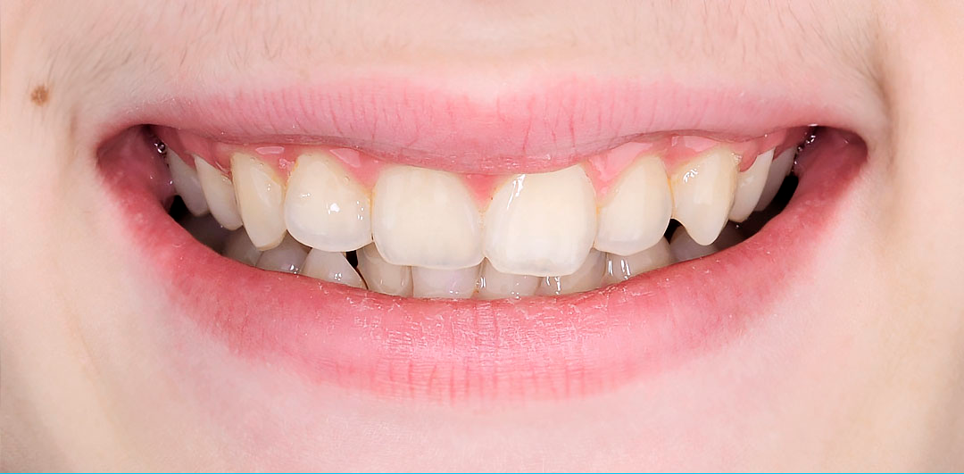 ЛЕЧЕНИЕ ПЕРЕКРЕСТНОГО ПРИКУСА, УСТРАНЕНИЕ СКУЧЕННОСТИ ЗУБОВ. 