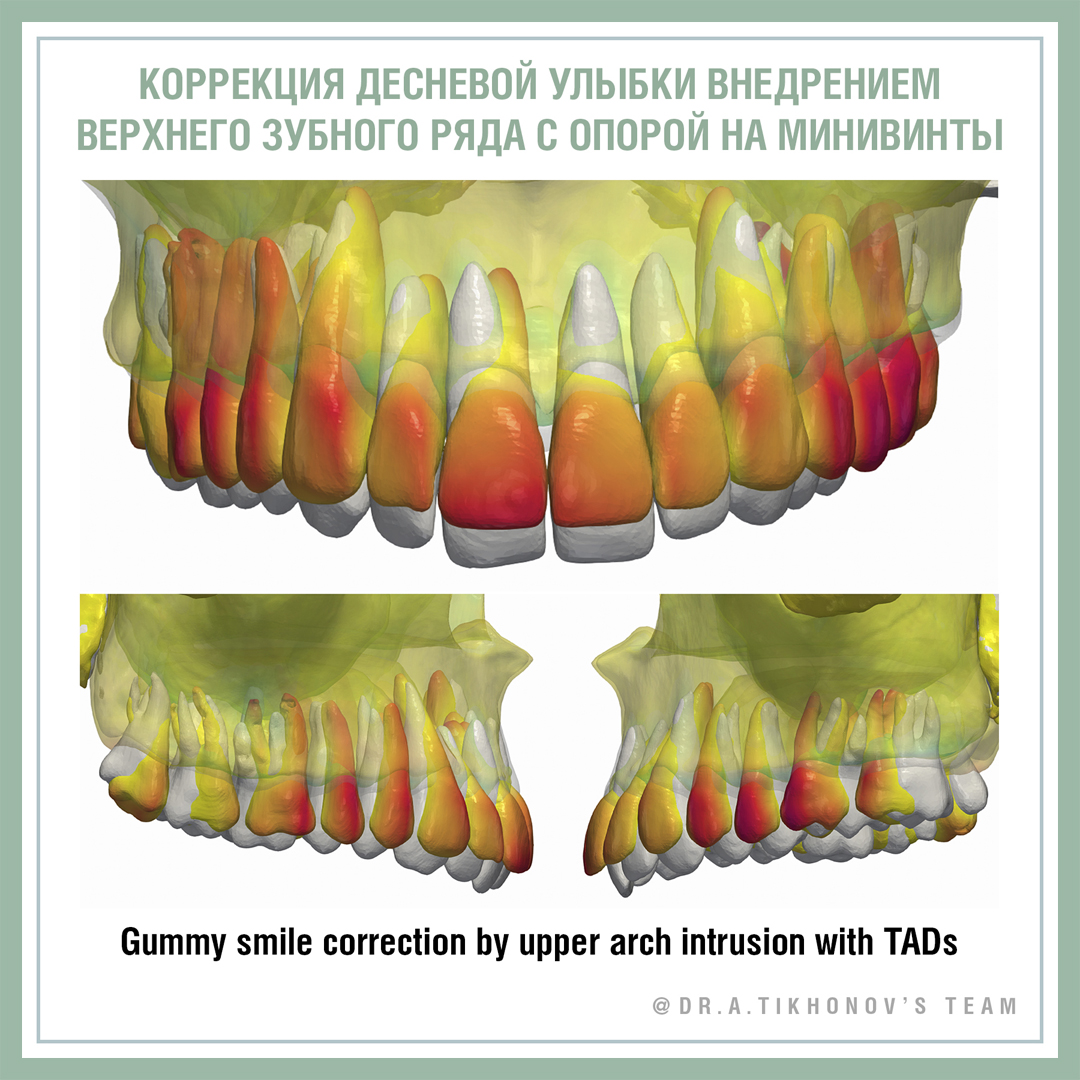 А.В. Тихонов – внедрение верхнего зубного ряда
