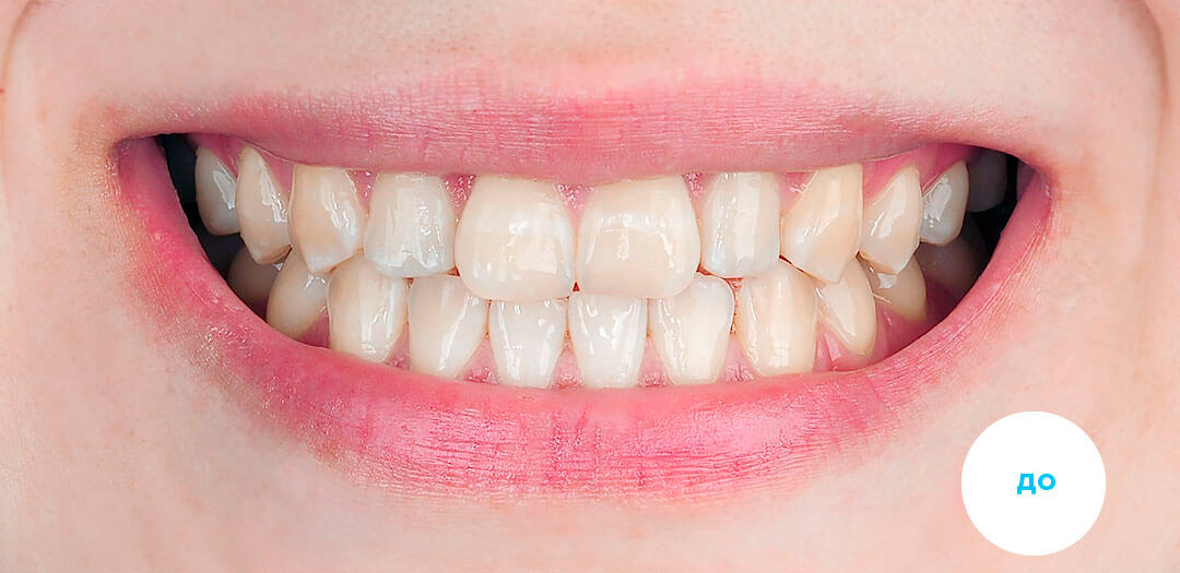 ЛЕЧЕНИЕ ПЕРЕКРЕСТНОГО ПРИКУСА, УСТРАНЕНИЕ СКУЧЕННОСТИ ЗУБОВ. 