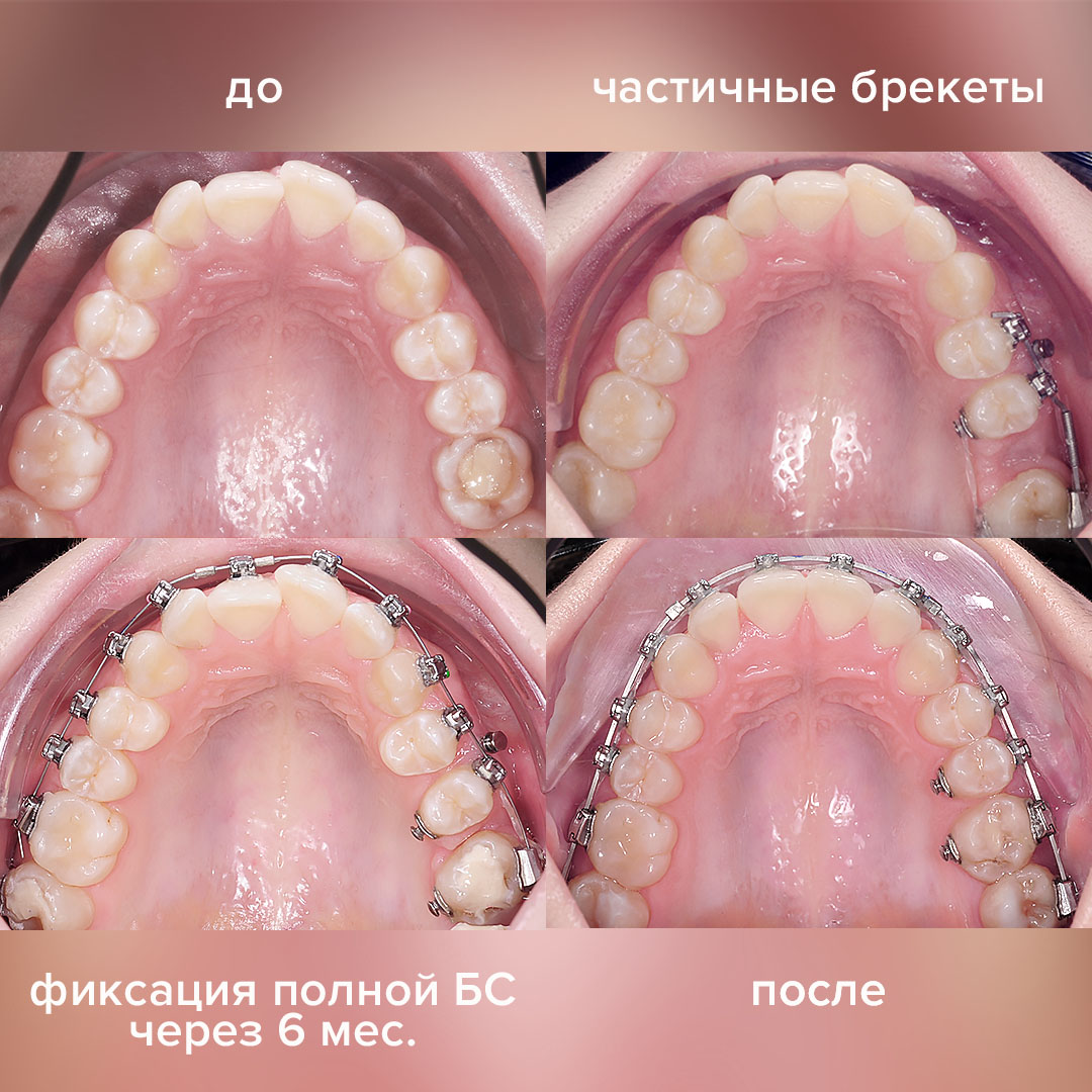 ЗАКРЫТИЕ ПРОМЕЖУТКА ОТ УДАЛЕННОГО МОЛЯРА