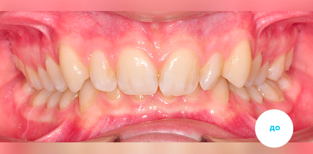 ЛЕЧЕНИЕ ПЕРЕКРЕСТНОГО ПРИКУСА, УСТРАНЕНИЕ СКУЧЕННОСТИ ЗУБОВ. 