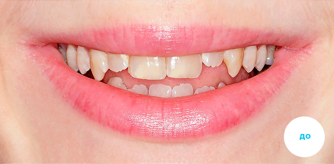 ЛЕЧЕНИЕ ПЕРЕКРЕСТНОГО ПРИКУСА, УСТРАНЕНИЕ СКУЧЕННОСТИ ЗУБОВ. 