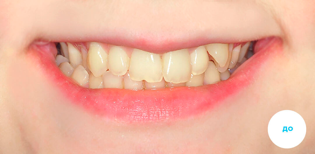 ЛЕЧЕНИЕ ПЕРЕКРЕСТНОГО ПРИКУСА, УСТРАНЕНИЕ СКУЧЕННОСТИ ЗУБОВ. 