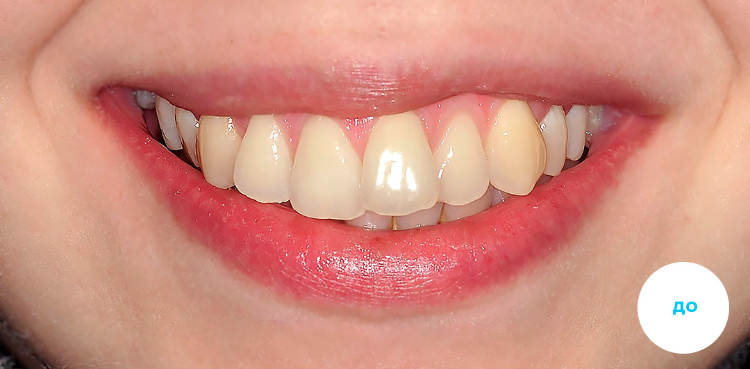 ЛЕЧЕНИЕ ПЕРЕКРЕСТНОГО ПРИКУСА, УСТРАНЕНИЕ СКУЧЕННОСТИ ЗУБОВ. 