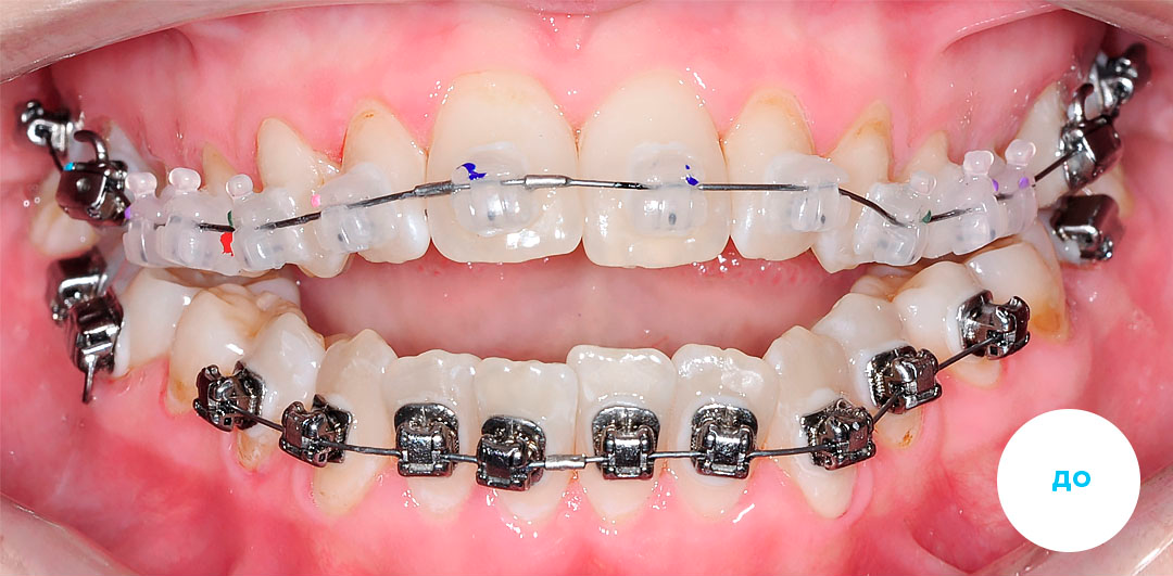 ЛЕЧЕНИЕ ПЕРЕКРЕСТНОГО ПРИКУСА, УСТРАНЕНИЕ СКУЧЕННОСТИ ЗУБОВ. 