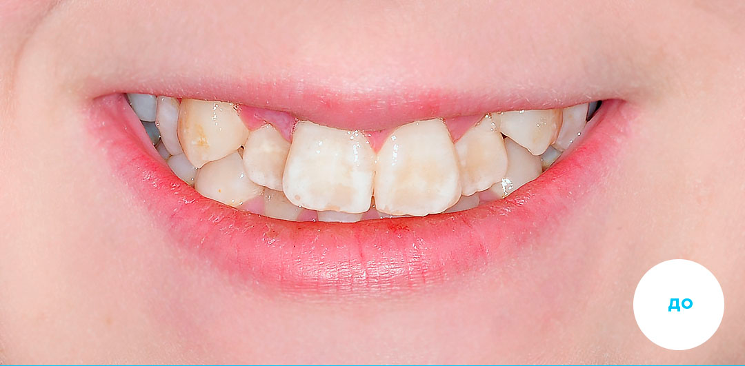 ЛЕЧЕНИЕ ПЕРЕКРЕСТНОГО ПРИКУСА, УСТРАНЕНИЕ СКУЧЕННОСТИ ЗУБОВ. 