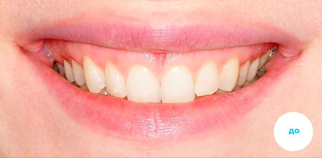 ЛЕЧЕНИЕ ПЕРЕКРЕСТНОГО ПРИКУСА, УСТРАНЕНИЕ СКУЧЕННОСТИ ЗУБОВ. 