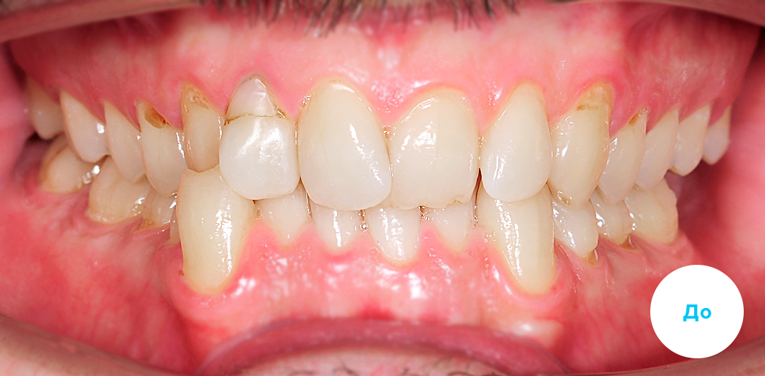 ЛЕЧЕНИЕ ПЕРЕКРЕСТНОГО ПРИКУСА, УСТРАНЕНИЕ СКУЧЕННОСТИ ЗУБОВ. 