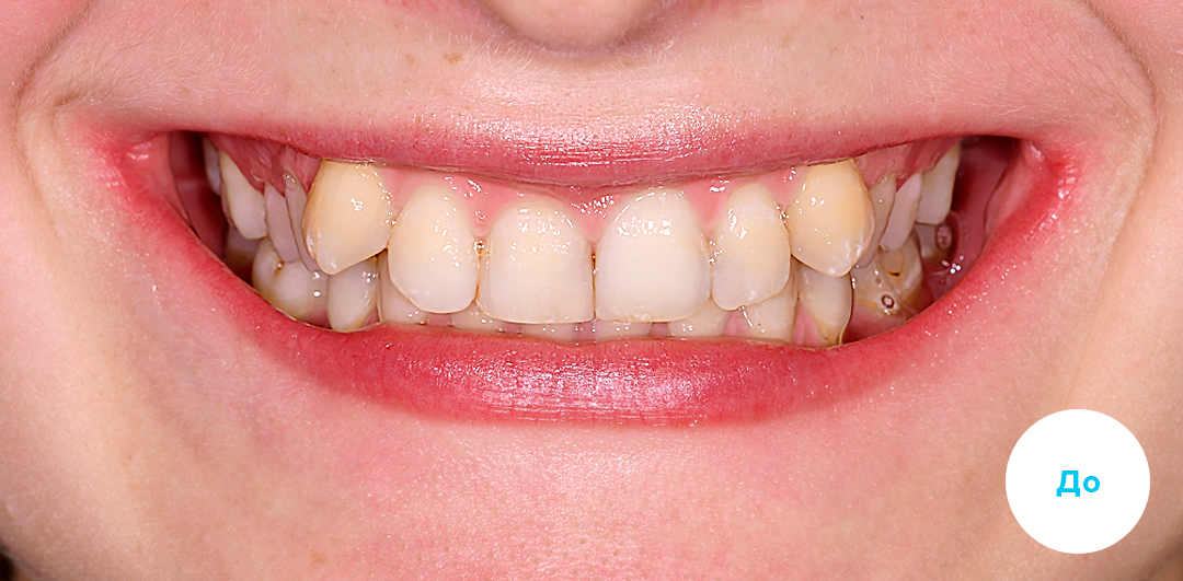 ЛЕЧЕНИЕ ПЕРЕКРЕСТНОГО ПРИКУСА, УСТРАНЕНИЕ СКУЧЕННОСТИ ЗУБОВ. 