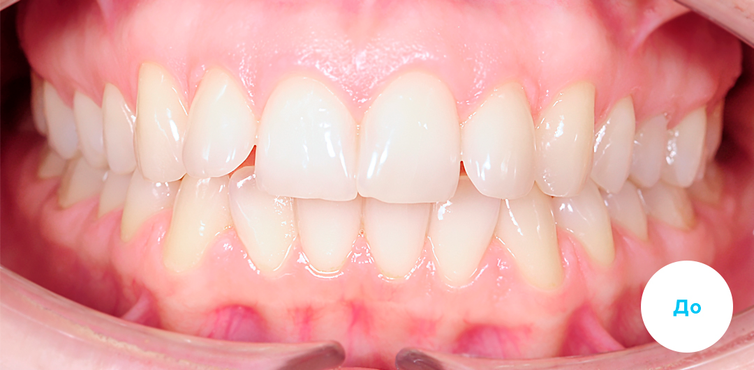 ЛЕЧЕНИЕ ПЕРЕКРЕСТНОГО ПРИКУСА, УСТРАНЕНИЕ СКУЧЕННОСТИ ЗУБОВ. 