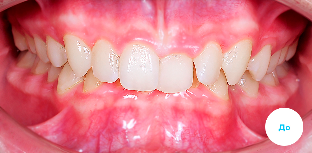 ЛЕЧЕНИЕ ПЕРЕКРЕСТНОГО ПРИКУСА, УСТРАНЕНИЕ СКУЧЕННОСТИ ЗУБОВ. 