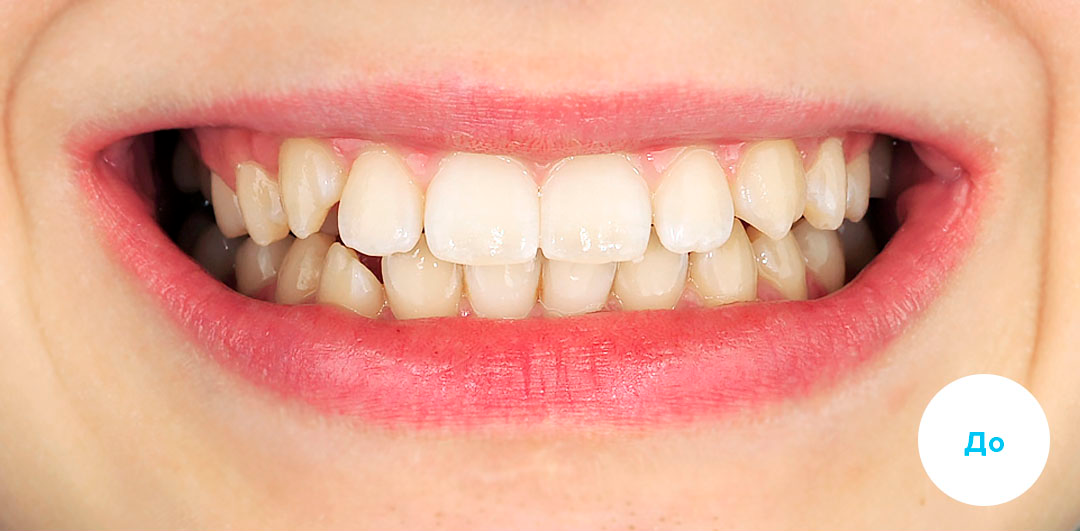 ЛЕЧЕНИЕ ПЕРЕКРЕСТНОГО ПРИКУСА, УСТРАНЕНИЕ СКУЧЕННОСТИ ЗУБОВ. 