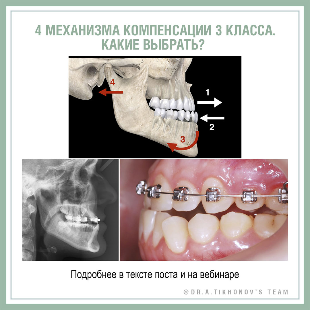 4 механизма компенсации 3 класса. Какие выбрать?