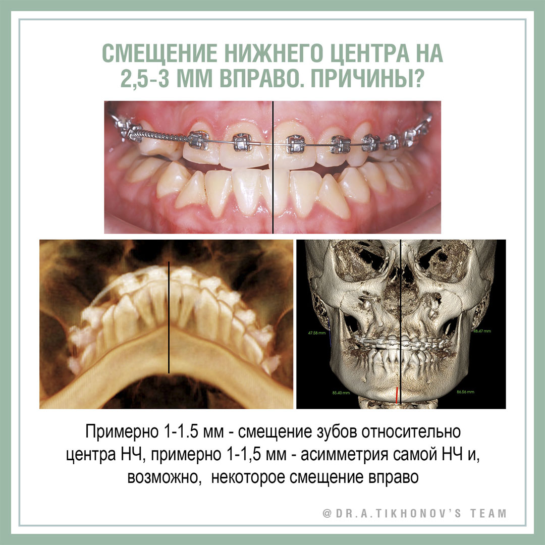 Смещение нижнего центра на 2,5-3 мм вправо. Причины?