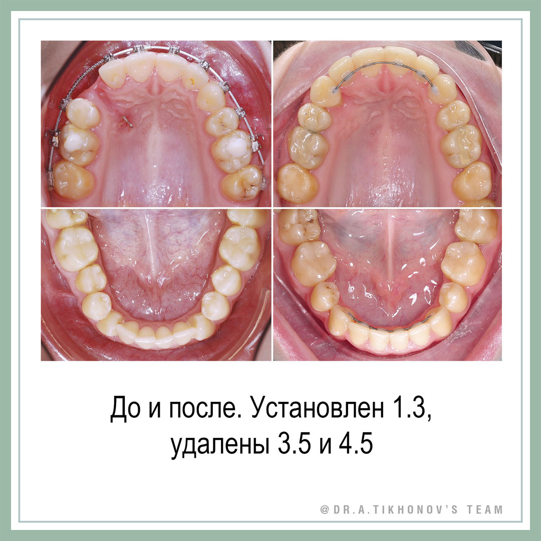 До и после. Установлен 1.3, удалены 3.5 и 4.5