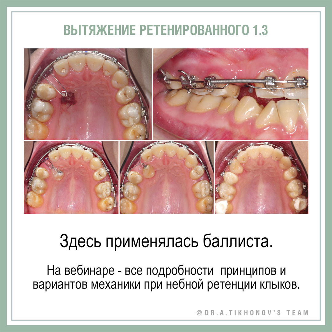 Вытяжение ретенированного 1.3