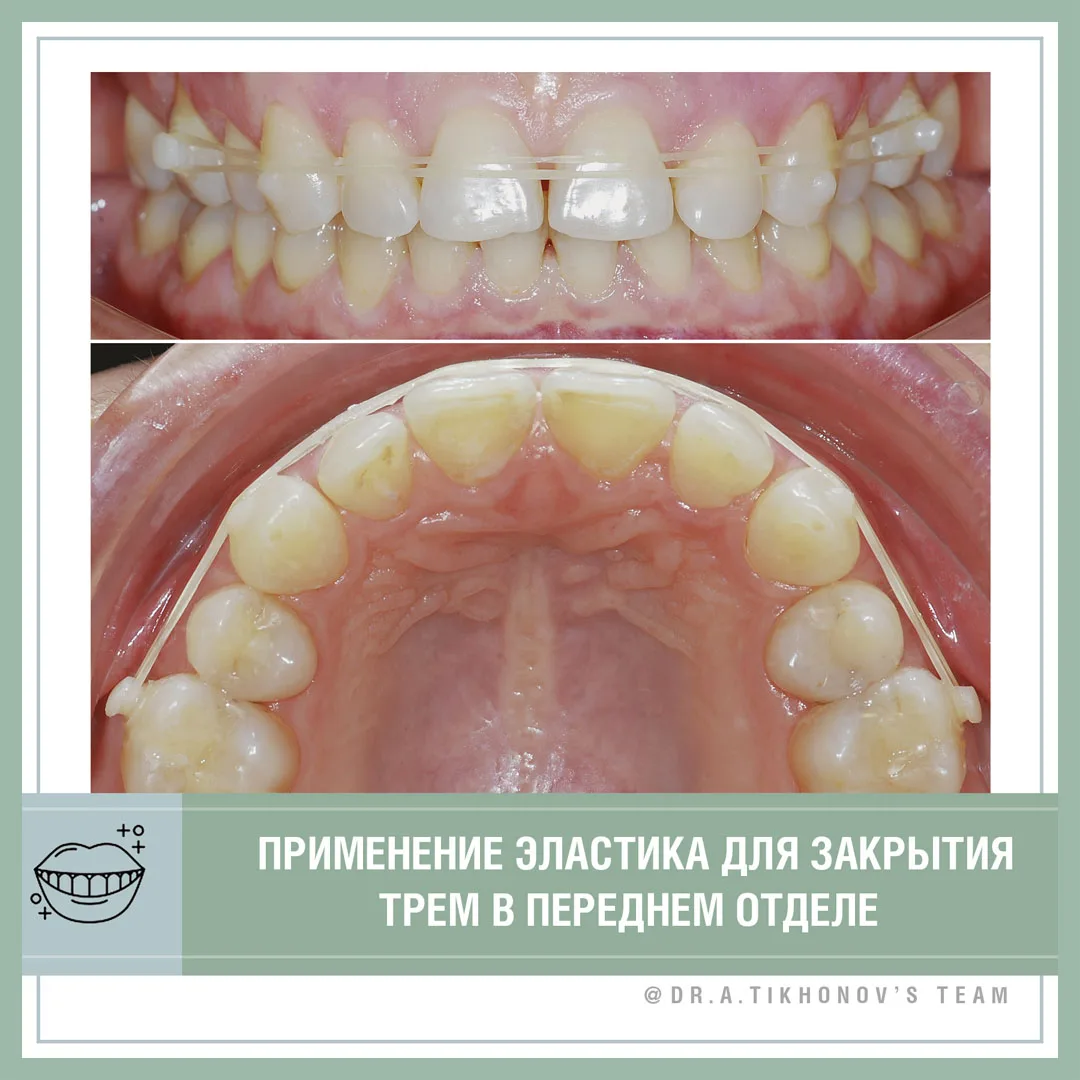 Коррекция трем эластиками