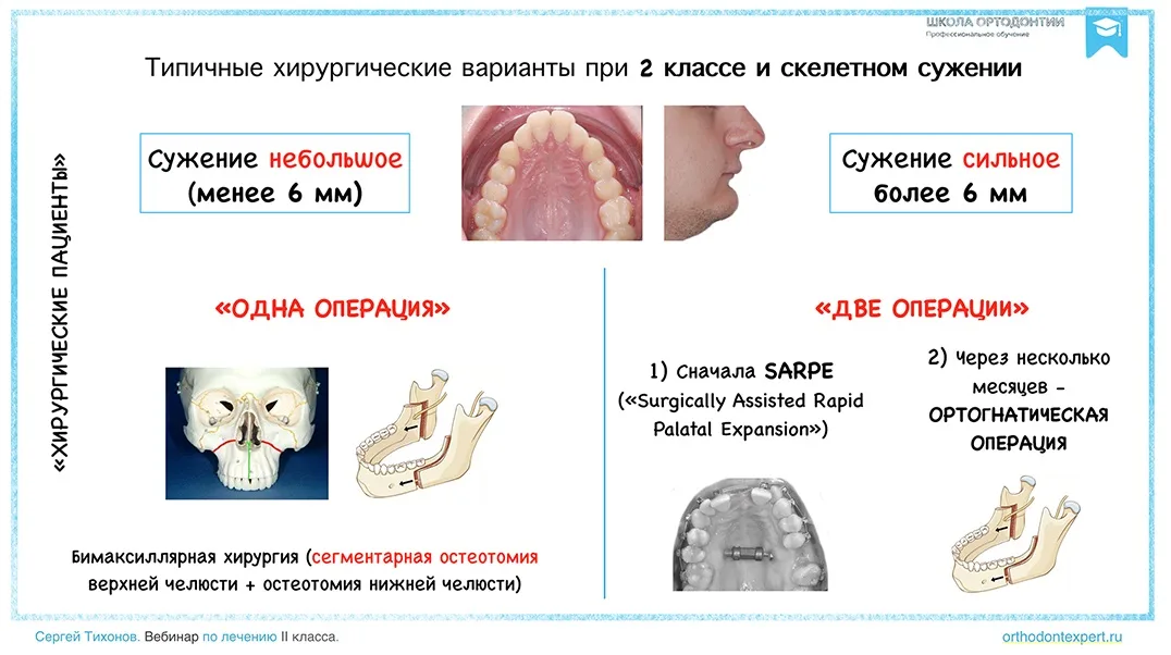 Типичные хирургические варианты при 2 классе и скелетном сужении