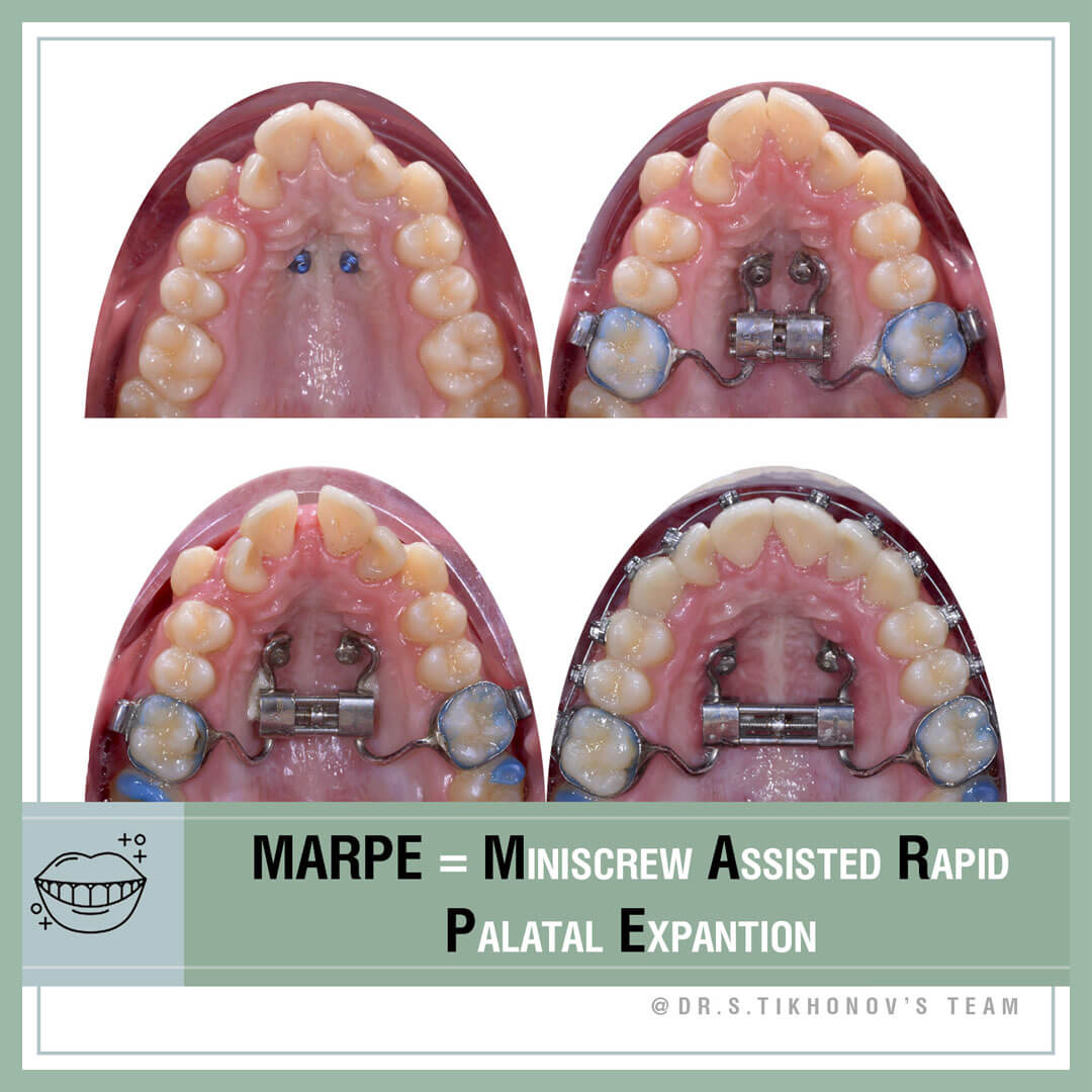 MARPE = Miniscrew Assisted Rapid Palatal Expantion.