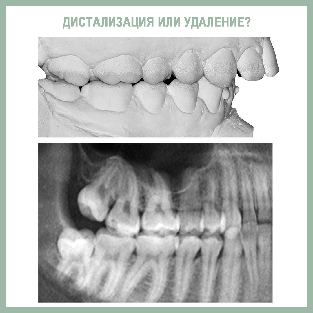 Дистализация или удаление?