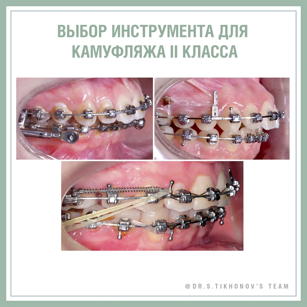 Выбор инструмента для камуфляжа II класса